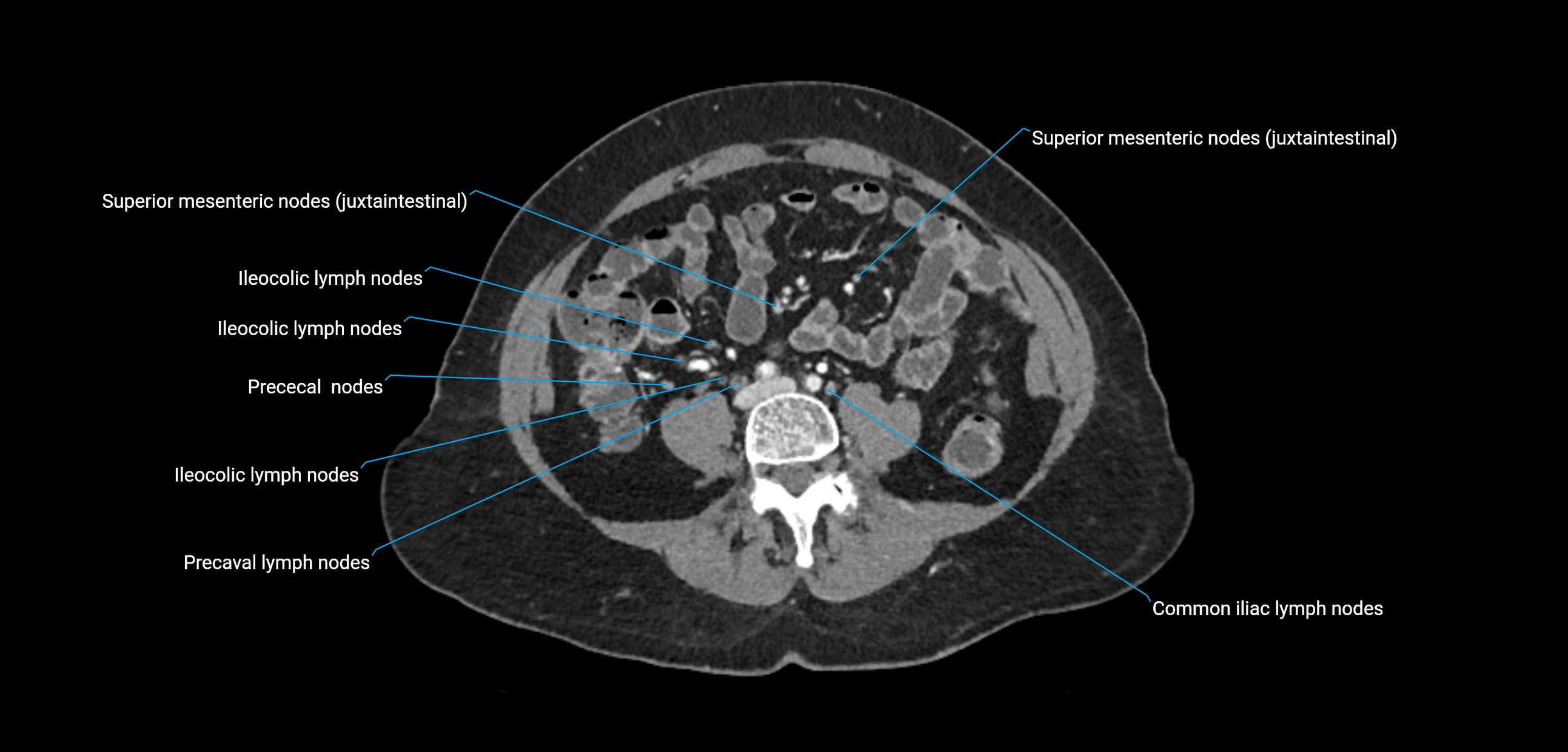 CT ct abdominal lymph nodes  axial cross sectional anatomy  enchanced radiology image -img-00002-00276.webp